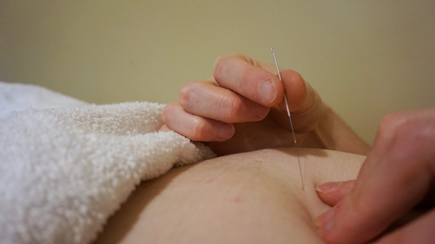 Acupuncture